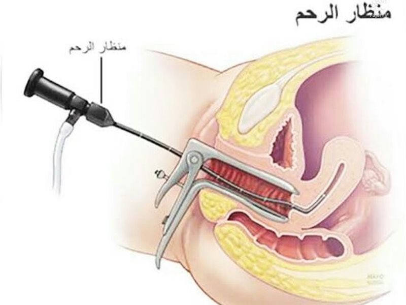 منظار الرحم